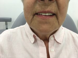 Resultado de los implantes superiores en la cara de satisfacción de Carmen