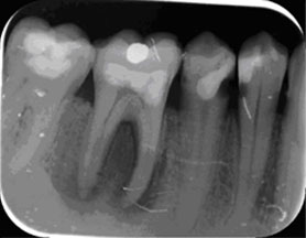 endodoncia1