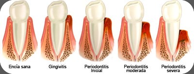 gingivitis
