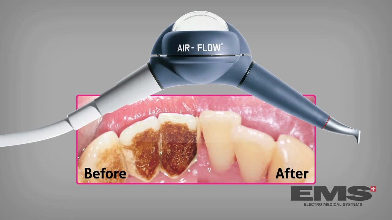 periodontitis